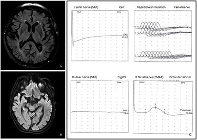 Ophthalmoplegia Due to Miller Fisher Syndrome in a Patient With Myasthenia Gravis